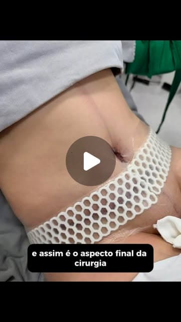 Capa do Reel: abdome após a cirurgia, com curativo cirúrgico e a legenda “e assim é o aspecto final da cirurgia”